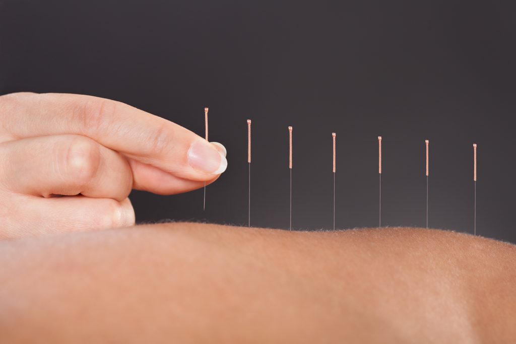 accupuncture calgary